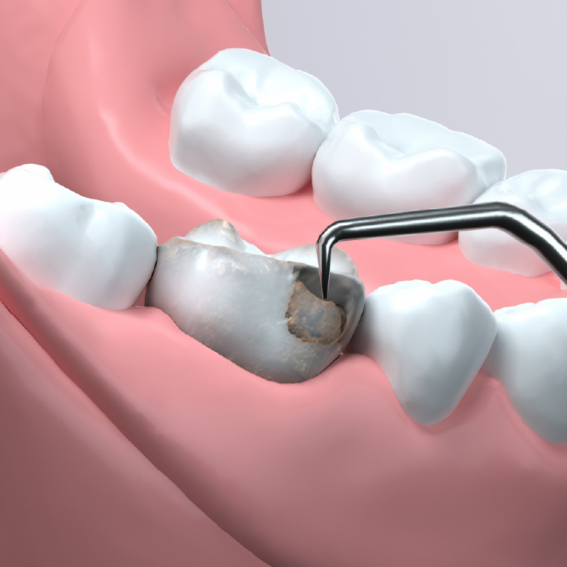 根管治療後の仕上げ：「MI治療」で歯を完成させる