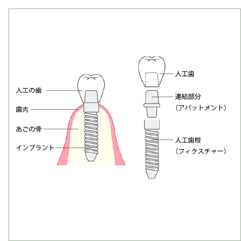 インプラントの基本構造
