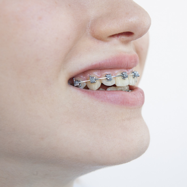 大人の矯正治療