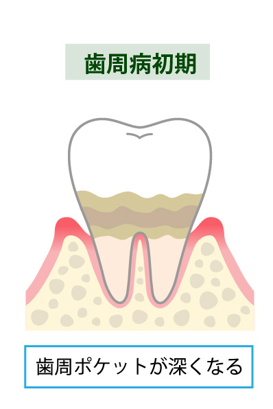 歯周病治療のステップ