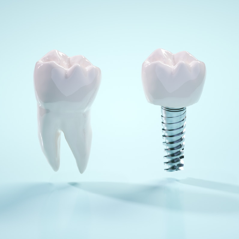 歯を失ってしまったらインプラント治療